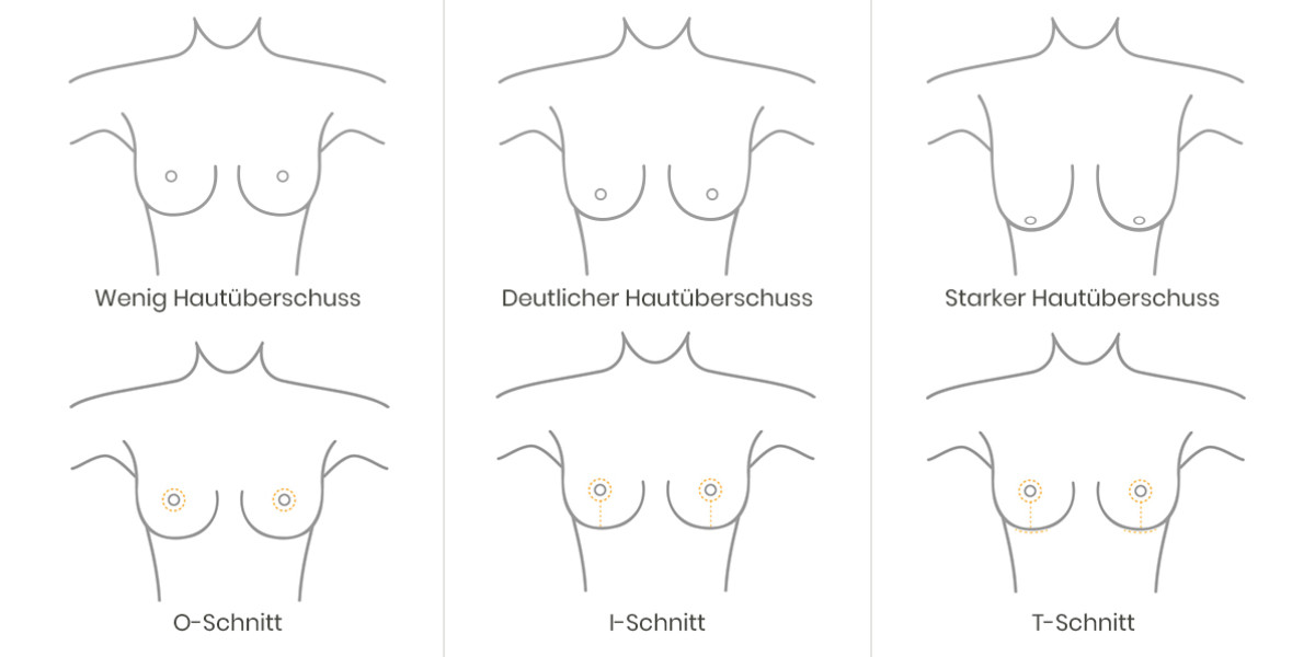 Die Schnittführungen der verschiedenen Methoden einer Brustverkleinerung