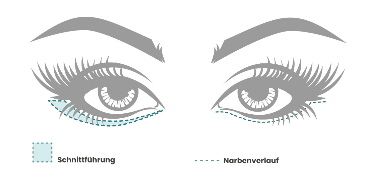 Schnittführung der Unterlidstraffung